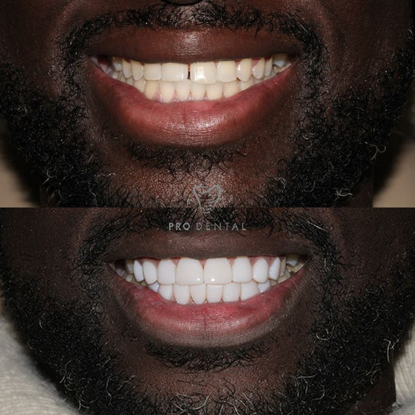 Ultra Smile - élimine les taches,  les odeurs et blanchit les dents (Résultat Garantie - Dernières pièces restantes) Bf